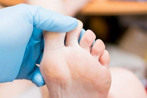 چگونه بهترین دکتر میخچه پا را بشناسیم؟