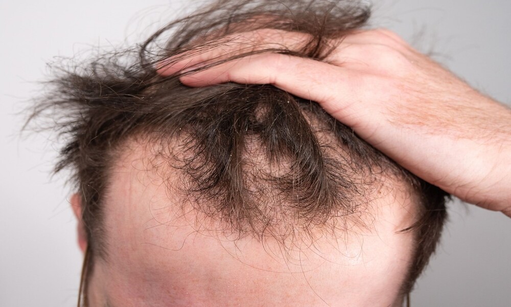 درمان-ریزش-مو (2)